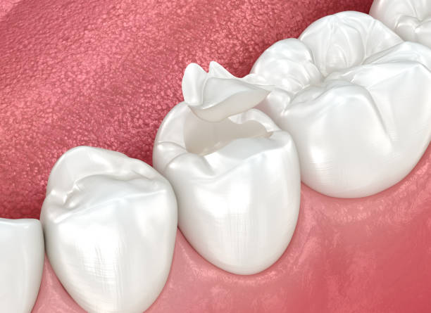 Best Dental Fillings (Composite and Amalgam)  in Parkland, WA